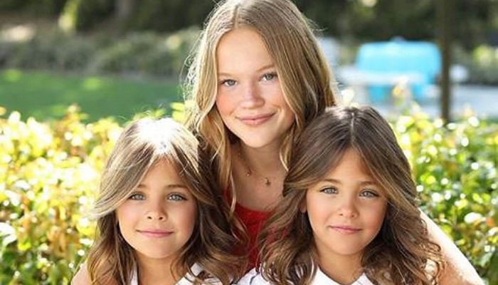 These Twins Were Named “most Beautiful In The World ” Wait Till You See Them Today